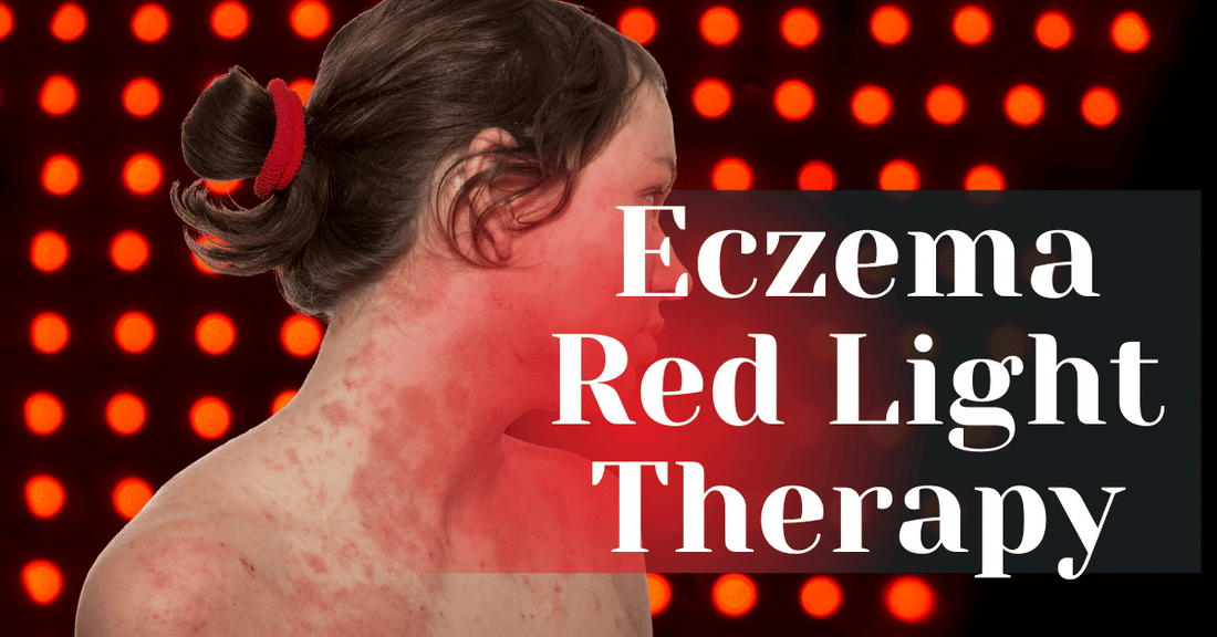 A blog featured image showing a woman with eczema.