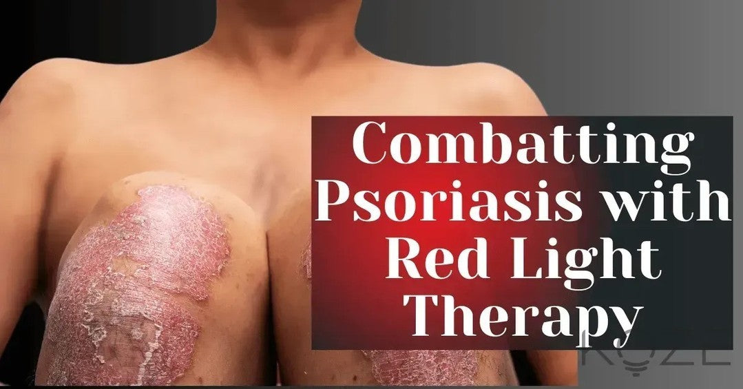 Supplements for Psoriasis: What You Need to Know