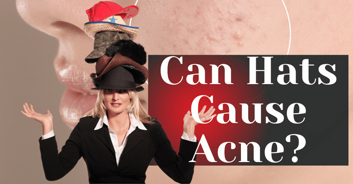 Can Hats Cause Acne?