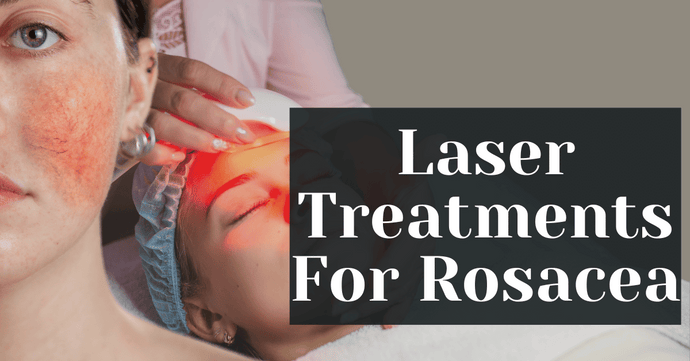 Laser Treatments For Rosacea