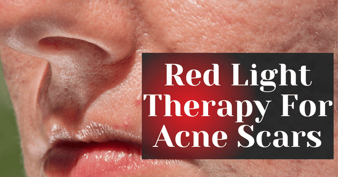 Red Light Therapy For Acne Scars