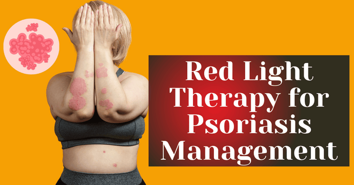 Red Light Therapy for Psoriasis Management