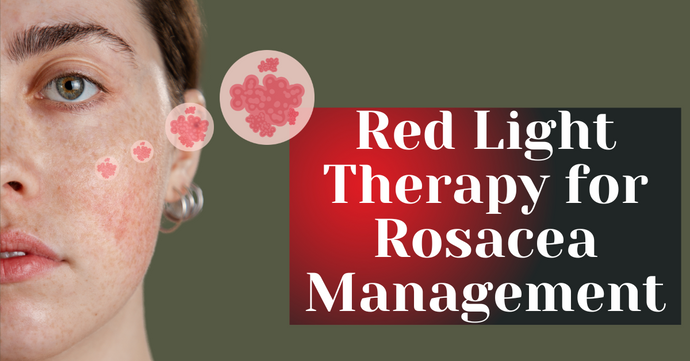 Red Light Therapy for Rosacea Management