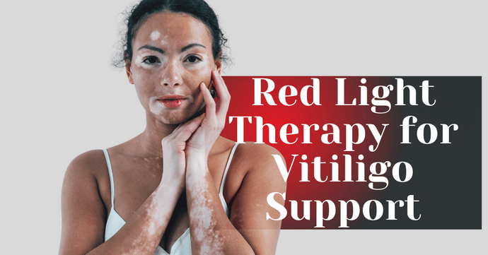 Red Light Therapy for Vitiligo Support