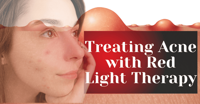 Treating Acne with Red Light Therapy