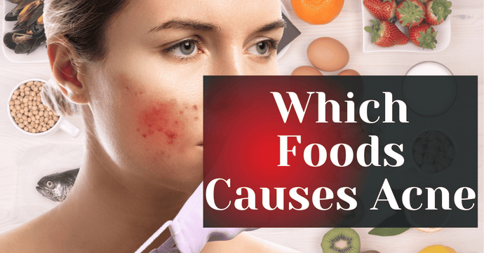 Which Foods Causes Acne